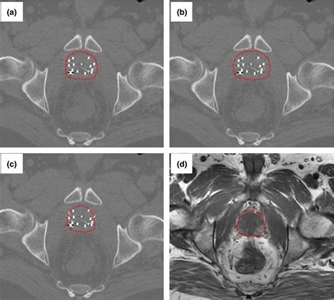 Improved Prostate Delineation In Prostate Hdr Brachytherapy With Trus