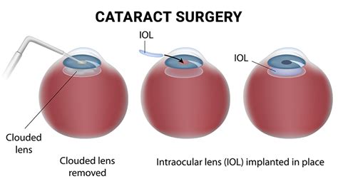 Cataract Surgery NYC | Сataract EYE Treatment in New York