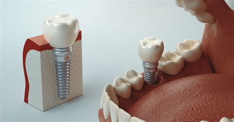 Cirurgia De Implante Dent Rio Cuidados No P S Operat Rio