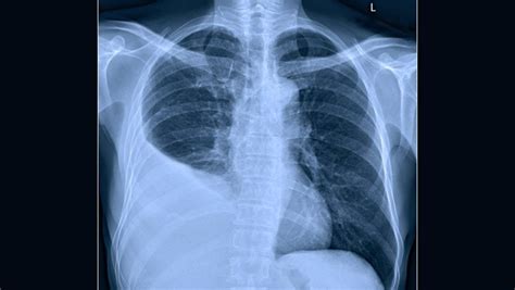 DERRAME PLEURAL Causas sintomas e tratamento MD Saúde