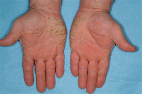 Chronic Hand Dermatitis: Case-based Approaches to Management