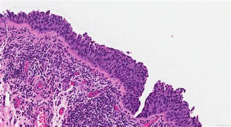 Urothelial Carcinoma In Situ Archives Atlas Of Pathology