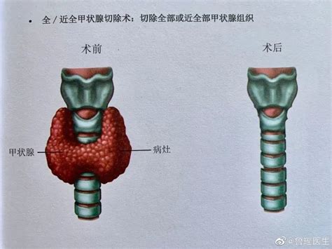 甲状腺结节“半切”还是“全切”，由“超声和甲穿”说了算！腾讯新闻