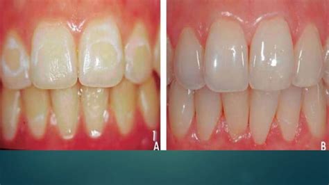 Control Of White Spot Lesions Using Fluoride Varnish In Orthodontic