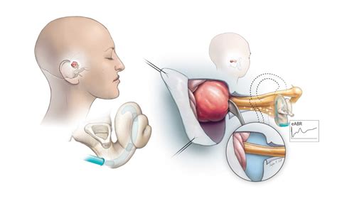 Acoustic Neuroma Otolaryngology Head And Neck Surgery