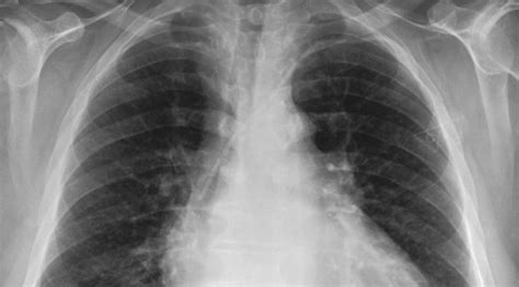 Identifying COVID-19 From Chest X-Rays with 95% Accuracy