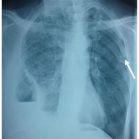 Pdf Open Window Thoracostomy For A Chronic Calcified Pleural Empyema