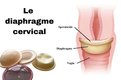 Contraception non Hormonale Préservatifs Cape et Diaphragme cervical