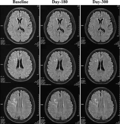 Efficacy Of Remote Ischemic Conditioning On Improving WMHs And