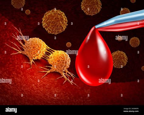 D Pistage Du Cancer Et Test Sanguin Pour La D Tection Pr Coce De