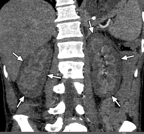 Manifestations Of Sickle Cell Disorder At Abdominal And Pelvic Imaging