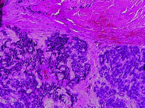 Photomicrographs Showing Extranodal Diffuse Large B Cell Lymphoma