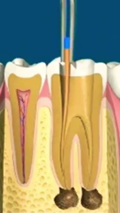 Root Canal Procedure Endodontic Treatment Dental Procedure Pulp Becomes Inflamed Or