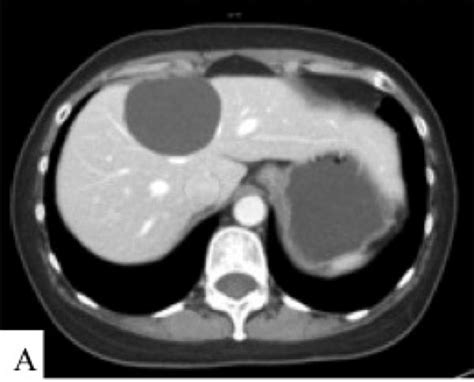 Cystic Neoplasms Of The Liver Biliary Cystadenoma And