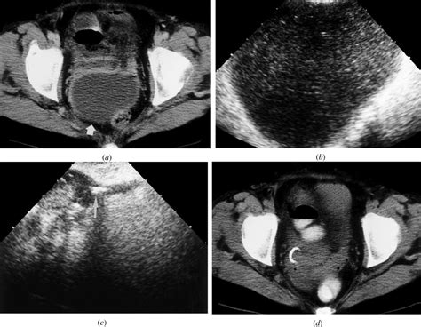 Ultrasound Guided Endocavitary Drainage Of Pelvic Abscesses Technique ...