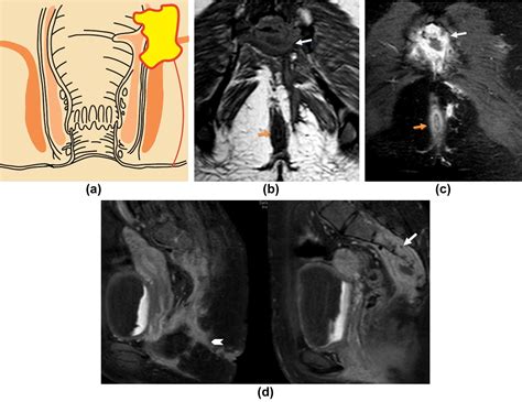 Mri Of Perianal Fistulae A Pictorial Kaleidoscope Clinical Radiology