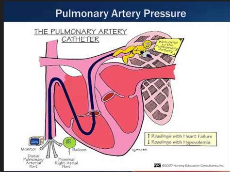 Chapter Hemodynamic Monitoring Flashcards Quizlet