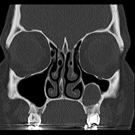 Maxillary odontogenic keratocyst | Radiology Case | Radiopaedia.org ...
