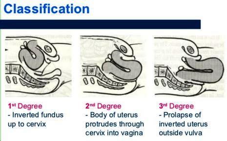 Inverted Uterus Diagram - Wiring Diagram Pictures