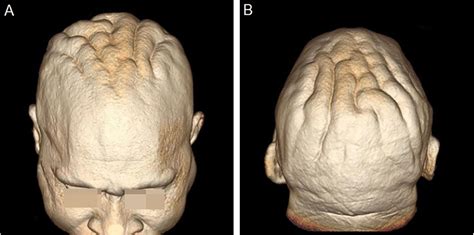 Cutis Verticis Gyrata Achado Cut Neo Na Acromegalia Anais