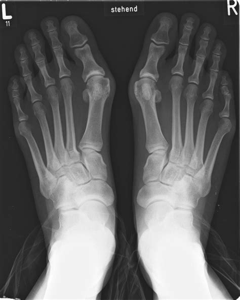 bunion pain treatment surgery britannica