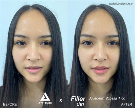 รีวิว Attitude Clinic เชียงราย รีวิวฉีดฟิลเลอร์ปาก อวบอิ่ม ฉ่ำ สายฝอ