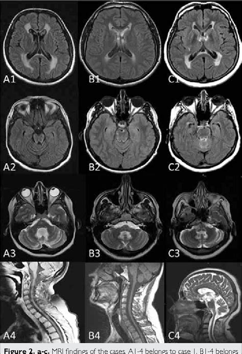 Table 1 From Familial Adult Onset Alexander Disease Clinical And