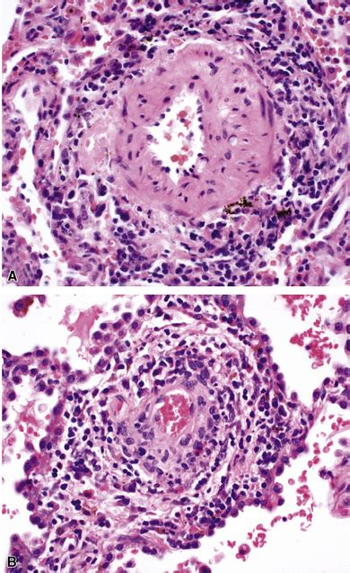 Vasculitis Histology