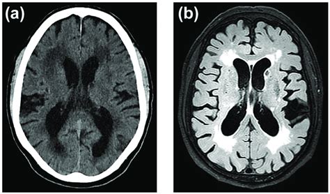 Leukoaraiosis in a 67-year-old hypertensive patient with occasional... | Download Scientific Diagram