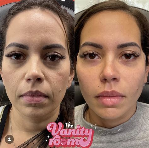 Dermal Fillers In Orlando Fl The Vanity Room Orlando