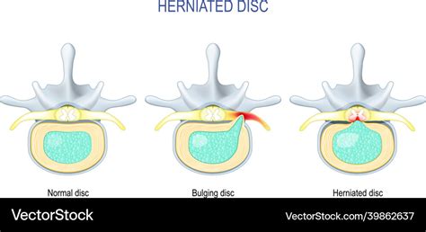 What Is The Difference Between A Herniated Disc And A Bulging Disc