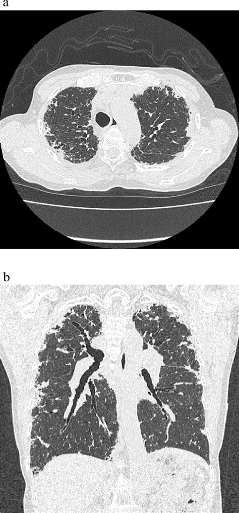 Ct Radiographs Of A Year Old Man With Idiopathic Ppfe A There