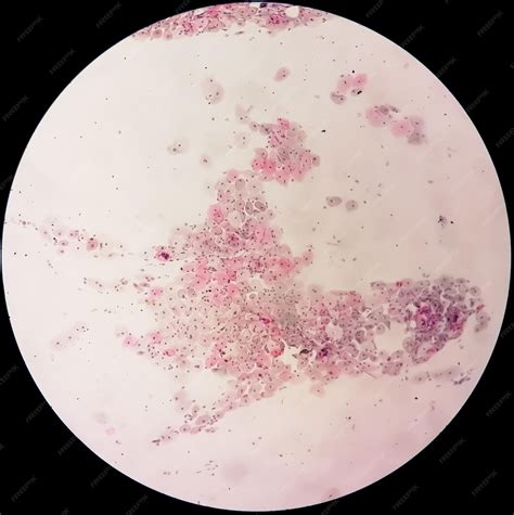 Premium Photo Microscopic View Of Trichomonas Vaginalis In Pap Smear With Acute Inflammatory Cells