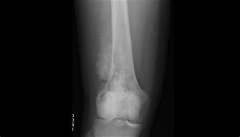 Ortho Dx Pain And Swelling In The Right Knee Clinical Advisor