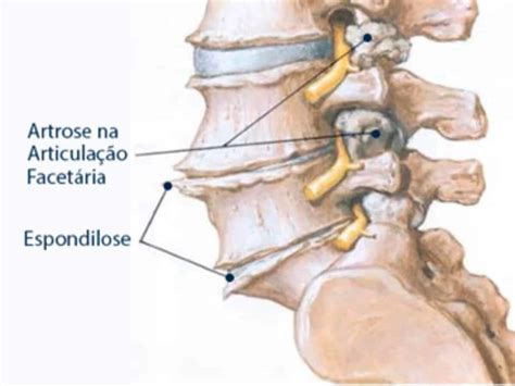 O Que Espondilose Cervical Itc Vertebral