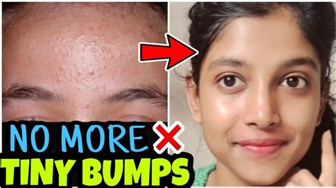 Small Bumps All Over Face Not Acne Archives Recipes And Beauty Tips