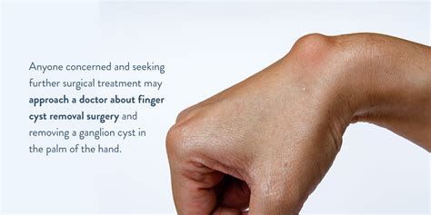 Ganglion Cyst Removal And Surgery Treatment And Aftercare Information