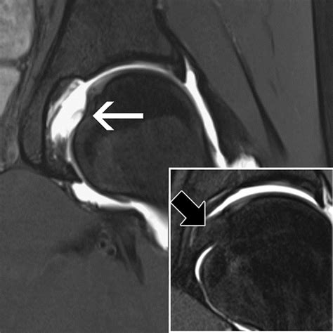 Hip Imaging In Athletes Sports Imaging Series Radiology