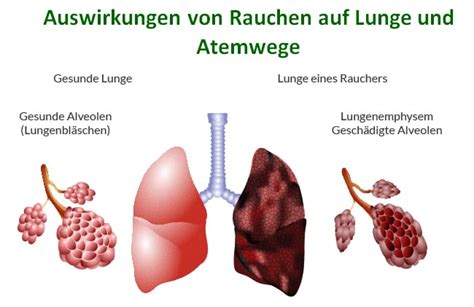 Chronisch Obstruktive Lungenerkrankung Erkaltung Ratgeber