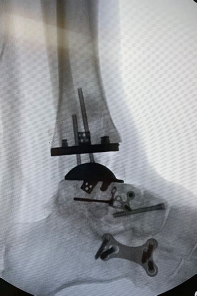 First Ankle Replacement Surgery Using The Vantage Ankle® Psi Patient