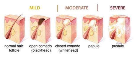 Stages And Severity Of Acne Diagram Acne Cure Acne Treatment