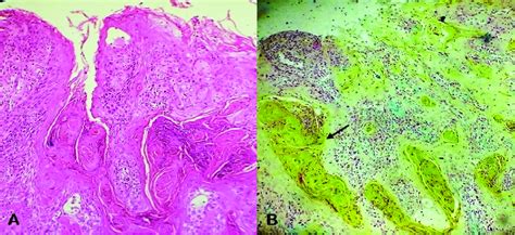 A Photomicrograph Showing Oral Squamous Cell Carcinoma Hematoxylin