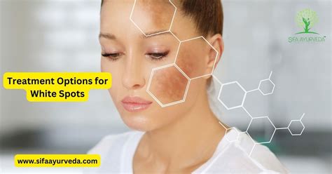 Why You Might Have White Spots on Your Skin – Sifa Ayurveda – 100% ...