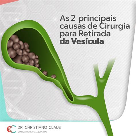 As Duas Principais Causas Da Cirurgia Para Retirada Da Ves Cula Dr