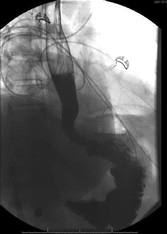 Post-POEM esophagram of the patient with type III achalasia who had no ...