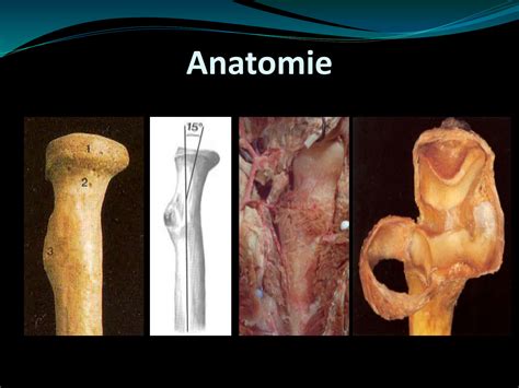 Solution Traumatismes Du Coude Fractures De La T Te Radiale Dr Nouri