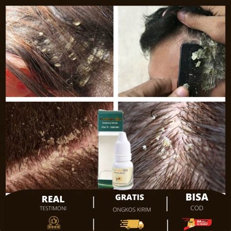 Jual Obat Penghilang Ketombe Berkerak Obat Ketombe Rambut Rontok