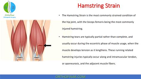 Hamstring Strain OrthoFixar 2024