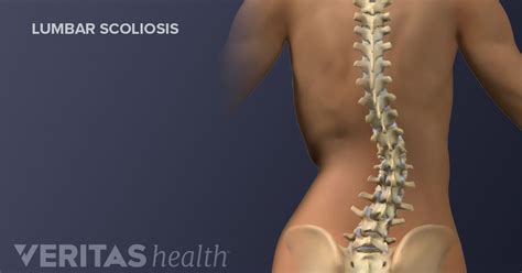 Scoliosis Treatment