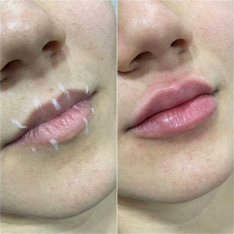 Preenchimento Labial Tudo Sobre O Procedimento O Que Como Feito